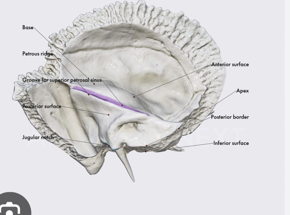 <p>Petrous ridge of temporal bone</p>