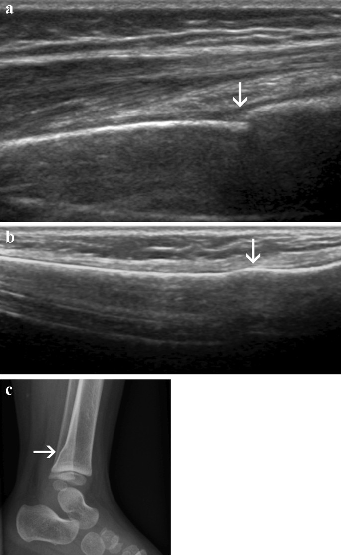 <p>Hyperechoic (bright) linear line with posterior acoustic shadowing due to complete reflect</p><p><strong>(high density of molecules</strong>, with <strong>hard material properties)</strong></p>