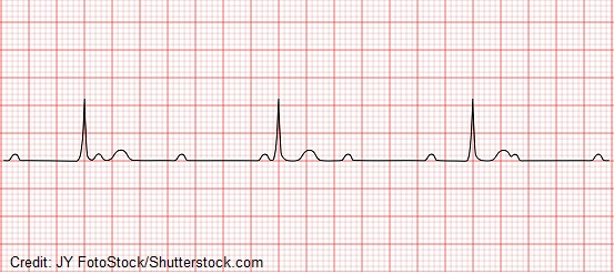 <p>no relation between P wave and QRS complex, P&gt;QRS</p>