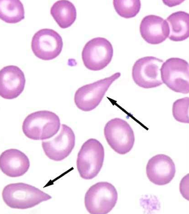* tear-drop shaped
* Nx in goats
* causes: Iron deficient camelids, Glomerulonephritis, Myeloproliferative disorders