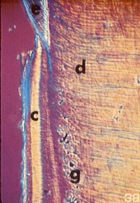 <p>hypomineralized dentin in the root </p>