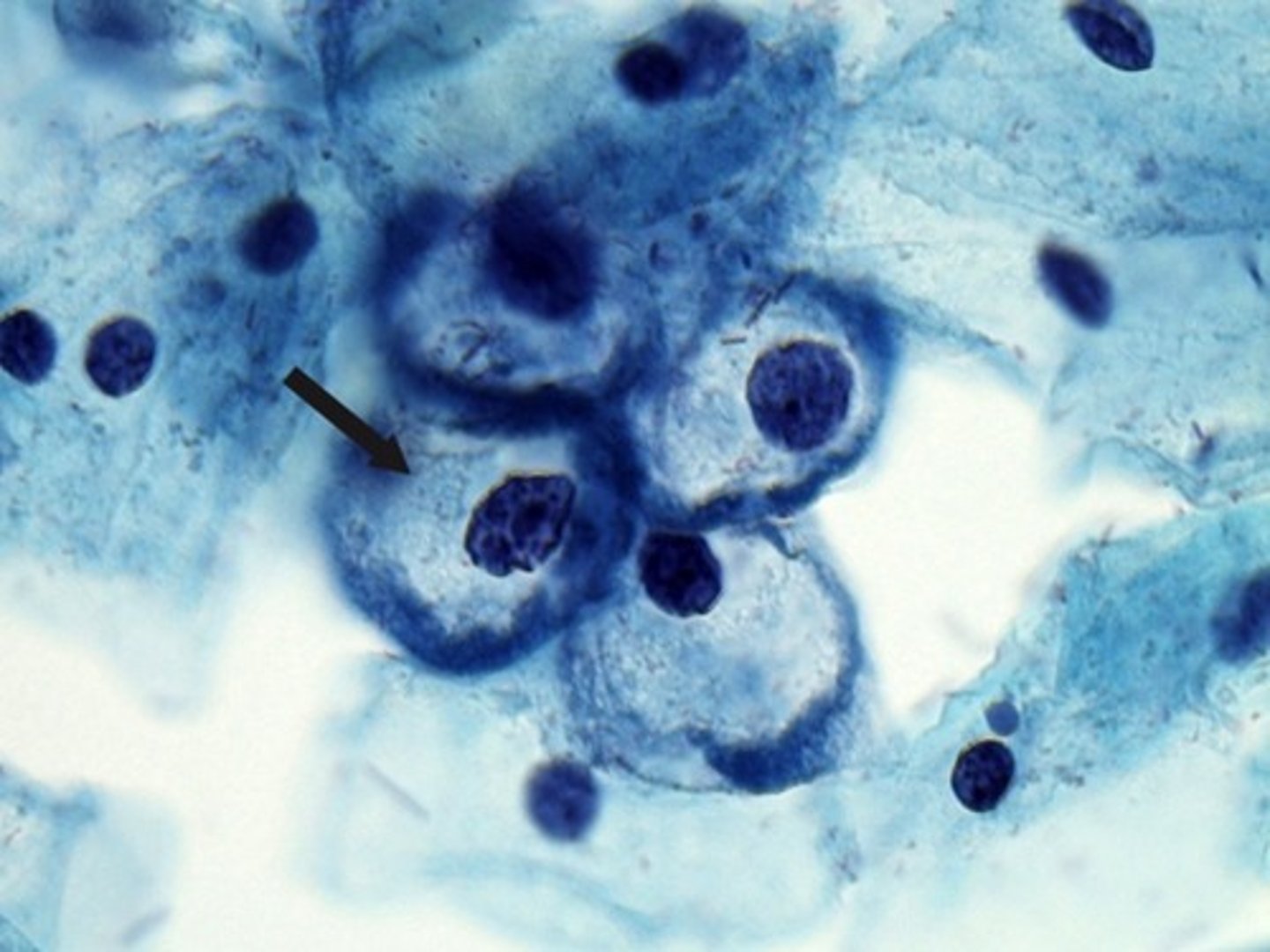 <p>Dx</p><p>-Post-Coital bleeding</p><p>Histo</p><p>-Koilocytes (Immature Squamous cell w/ dense irregular staining cytoplasm + perinuclear halo)</p>