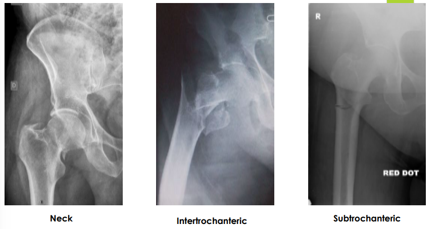 <p><strong>Hip Fractures: Symptoms and Diagnosis</strong></p><p>-S/S</p><ul><li><p>____ in hip and groin</p></li><li><p>Pain with ROM (especially ________ _________)</p></li><li><p>______ to bear weight. Individuals with osteoporosis may still be able to bear weight </p></li><li><p>Leg ____________ and __________ rotated, if the bone is displaced </p></li><li><p>± swelling and ecchymosis </p></li></ul><p>-Diagnosis</p><ul><li><p>X-ray</p></li><li><p>___ is the preferred imaging modality. Bone scans or CT are also options for occult fractures </p></li></ul><p></p>