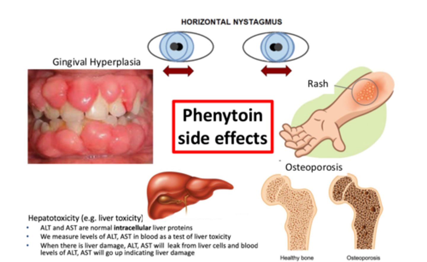 <p>Phenytoin</p><p>(1) Indication: epilepsy - 1st gen ASM</p><p>(2) Efficacy: narrow --- may exacerbate generalized seizures, including CAE</p><p>(3) Comorbid uses: N/A</p><p>(4) Side effects:</p><p>⚫️All Na+ channel inhibitors are "neurotoxic" - ataxia, sedation, decreased cognition</p><p>⚫️ Nystagmus common exam finding</p><p>⚫️ Long-term causes: gingival hyperplasia, osteoporosis</p><p>⚫️ idiosyncratic rash, hepatotoxicity</p><p>(5) DDI: INDUCER</p><p>(6) Therapeutic Range: TDM required (narrow)</p><p>(7) PK: Non-linear kinetics</p><p>(8) Binding: Lots of protein binding</p>