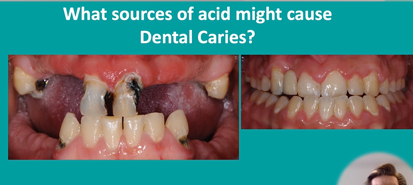 <p>what sources of acids might cause dental caries?</p>