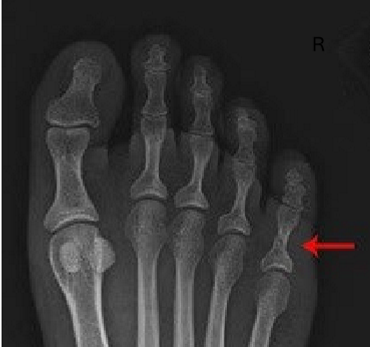 <p>open joints</p><ul><li><p>IPs</p></li><li><p>MTP</p></li></ul><p></p>