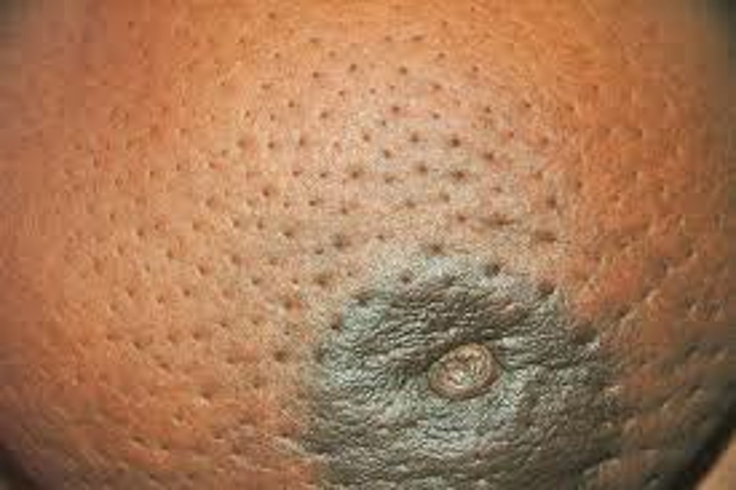 <ul><li><p>edema of the skin is produced by lymphatic blockade</p></li><li><p>appears as thickened skin with enlarged pores "orange peel"</p></li><li><p>often seen first in the lower portion of the breast or areola</p></li></ul><p></p>