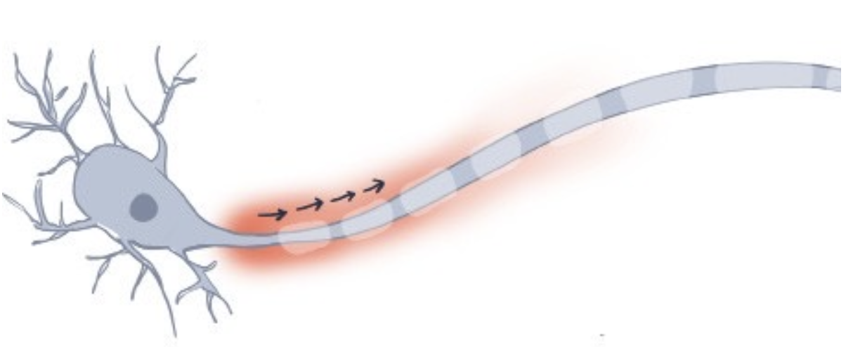 <p>excitatory potential is produced, but not sufficient to elicit an AP</p>