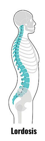 <p>exaggerated lumbar deviation/ curvature; normal during pregnancy </p>