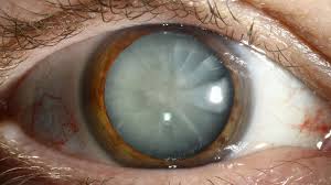 <p>affect the center of lens</p>
