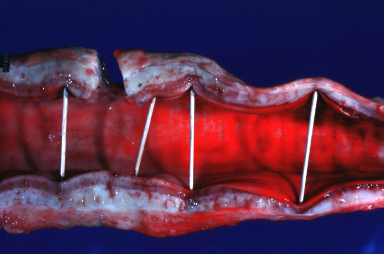 <p>Ox. Which is true about this lesion? </p><p>a. Most common in the early spring in feedlot cattle</p><p>b. Most common in the summer in cattle on lush pasture </p><p>c. Most common in the early spring in cattle on lush pasture  </p><p>d. Most common in the summer in feedlot cattle</p>