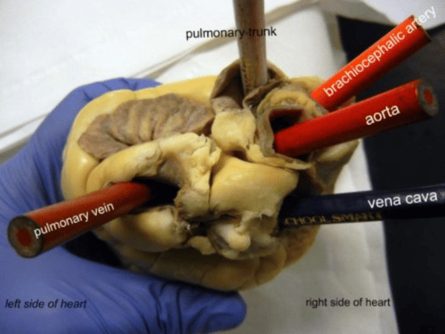 <p>blood vessel that transports blood from the lungs back to the heart</p>