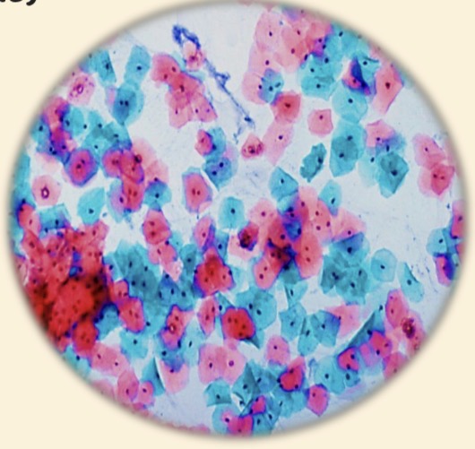 <p>Células epiteliales planas disociadas o exfoliadas del epitelio </p>
