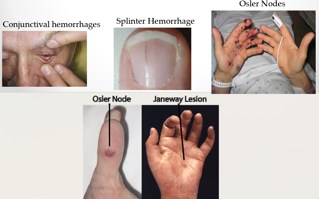 <p>lesions on palms or soles caused by septic emboli which deposity bacteria forming microabscesses</p>