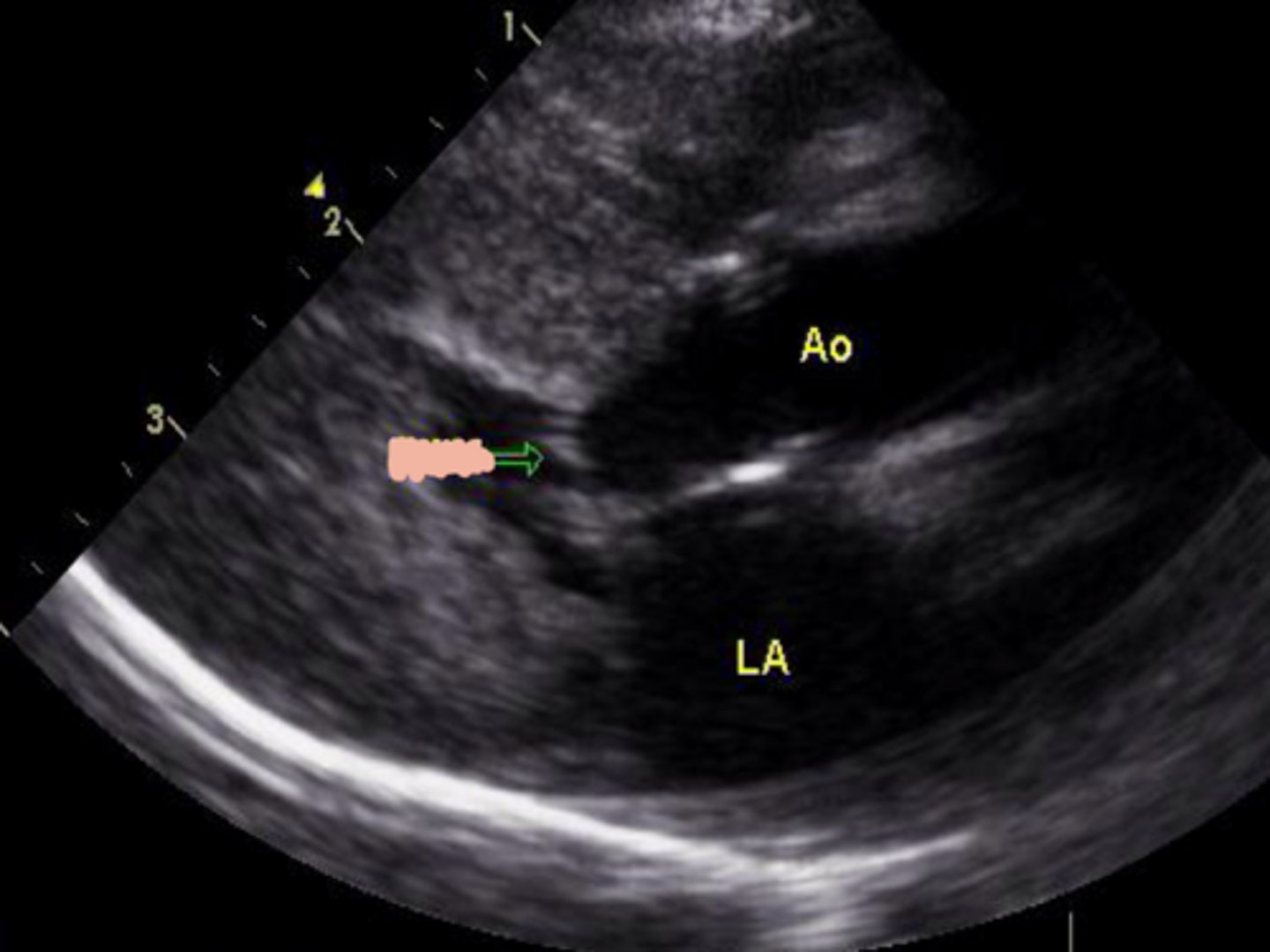 <p>Central papillary displacement</p><p>Chordal laxity</p>