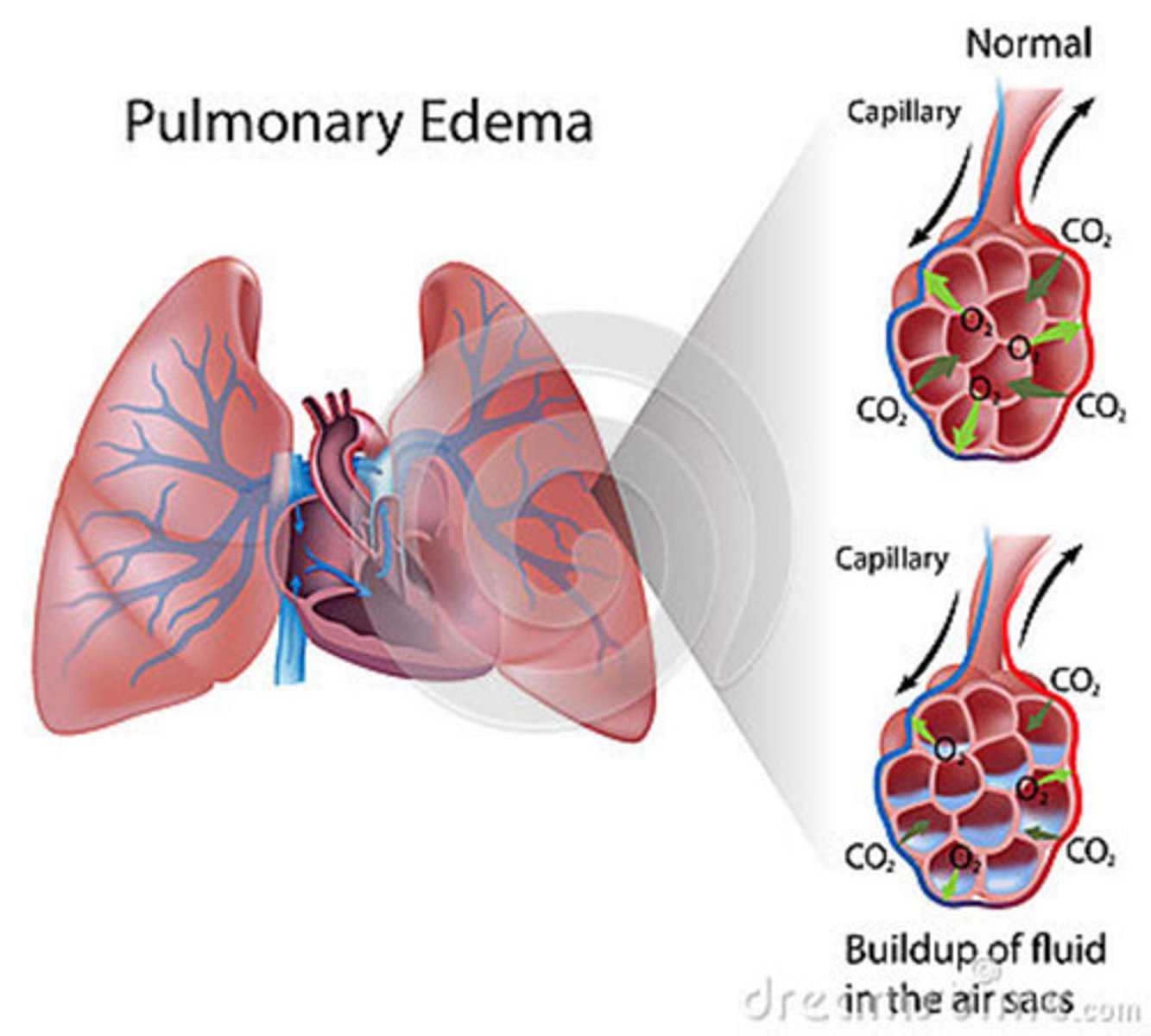 <p>Fluid in the lungs</p>