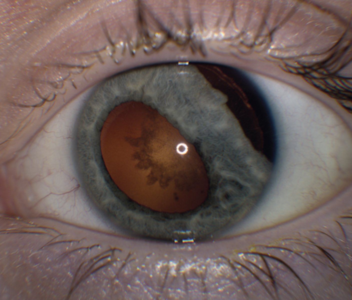 <p>It occurs secondary to high-velocity projectiles, high-impact blunt trauma, or sharp object injuries.</p>