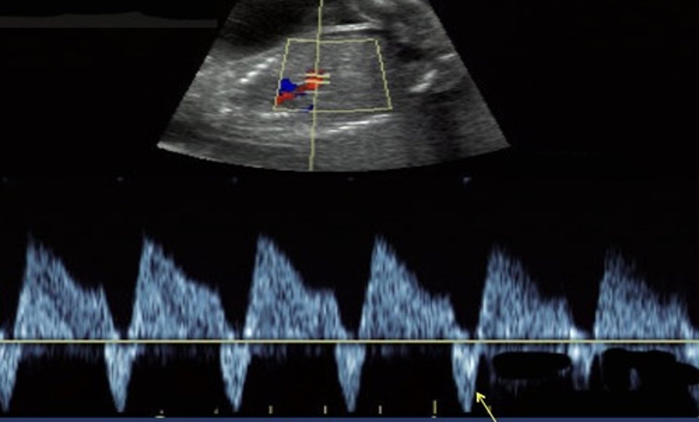 <p>Amniotic fluid discrepancy</p><p>Absent bladder in donor twin</p><p>ABNL umbilical artery S/D ratio in donor twin</p><p>Ductus venosus flow reversal in recipient twin</p>
