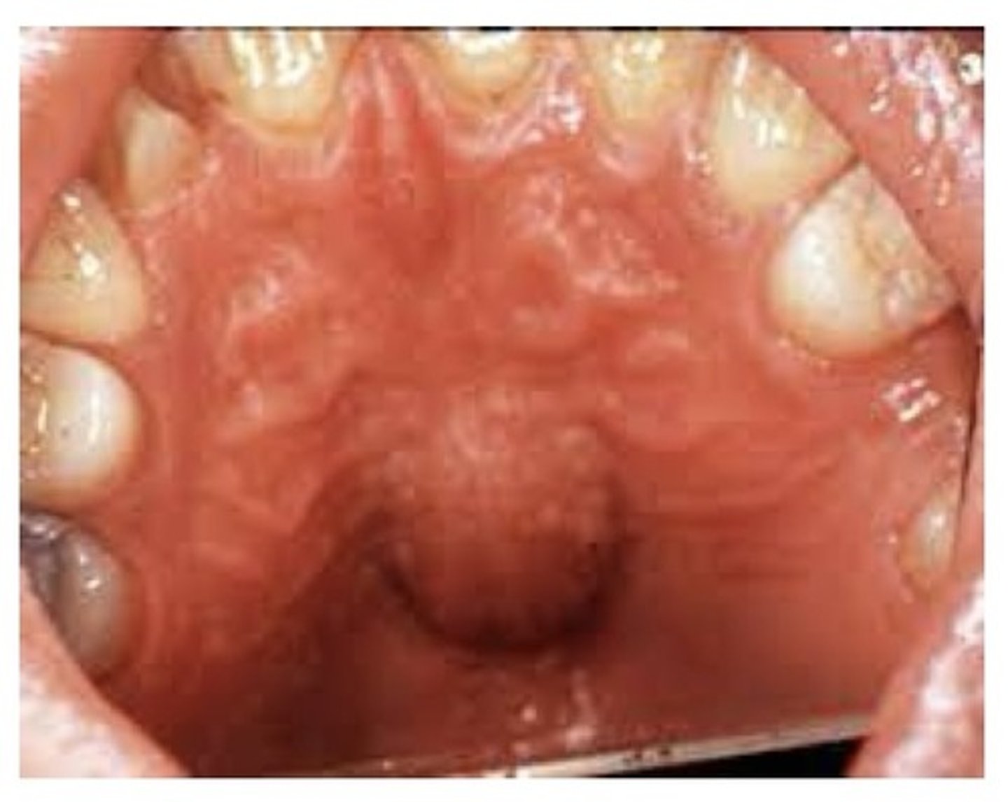 <p>A well-defined, unilocular radiolucency. Located in the midline of the hard palate. Lined with SSE surrounded by dense fibrous connective tissue. Tx: surgical removal.</p>