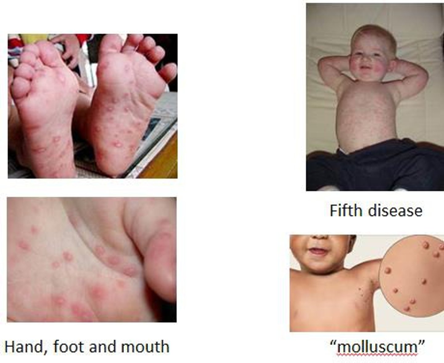 <p>Skin rashes caused by viral infections</p>