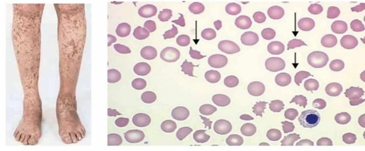 <p>Small red or purple spots from bleeding under skin.</p>