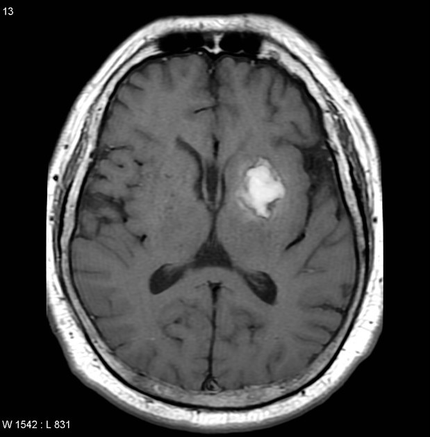 <p>Stroke where there is bleeding in the brain<br><br>Shows up as big bright spot on MRI/CT</p>