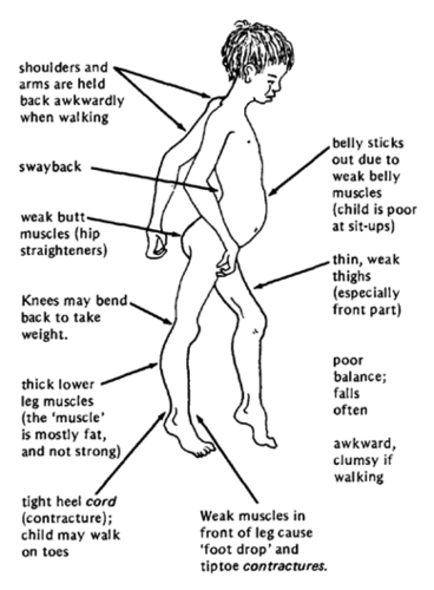 <p>Muscular Dystrophy</p><p>-results in the destruction of muscle cells and replacement with scar tissue</p><p>-Life expectancy is 20 years.</p>