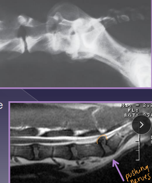 <ul><li><p><span style="color: rgb(136, 136, 136);"><strong>Et:</strong></span> <span style="color: red;"><strong>L7-S1/3 → spinal cord stops @ L5-6</strong></span></p><ul><li><p><strong>Degenerative:</strong> <strong><u>disc protrusion</u></strong>, lig hypertrophy, facet hypertrophy, spondylosis, <strong><u>instability</u></strong></p></li><li><p><strong>Congenital:</strong> stenosis, malformation, transitional vertebrae, end plate OC</p></li></ul></li><li><p><span style="color: rgb(136, 136, 136);"><strong>Sig:</strong> </span><strong>Lg, middle-aged, working dogs, GSD</strong></p></li><li><p><span style="color: rgb(136, 136, 136);"><strong>Cs:</strong></span> r<strong>eluctance to jump</strong>, stiff gait, low tail, <strong>incontinence</strong>, <strong>back pain, weakness(non-weight bearing), LMN signs(L4-3)</strong></p><ul><li><p><u>Patellar “pseudohyperreflexia”</u> – exaggerated reflex</p><ul><li><p>Sciatic affected, patellar reflex spared</p></li></ul></li></ul></li><li><p><span style="color: rgb(136, 136, 136);"><strong>Dt: </strong></span><strong>rads (spondylosis, narrowed disc)</strong>, CT, <strong>MRI(best)</strong></p></li><li><p><span style="color: rgb(136, 136, 136);"><strong>Tx:</strong></span><strong> </strong><u>NSAID, gabapentin, 4-6w rest,</u> <u>epidural steroid</u>s (MPA protocol: wk 0, 2, 6)</p><ul><li><p><strong><u>SX:</u></strong> laminectomy + discectomy = reoccurrence 1-2y esp. w/ lateral compression </p></li></ul></li></ul><p></p>