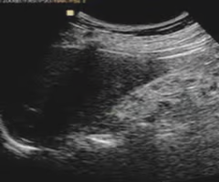 <p>With renal atrophy, kidneys appear ___ with a highly ___ sinus and a thin cortex </p>