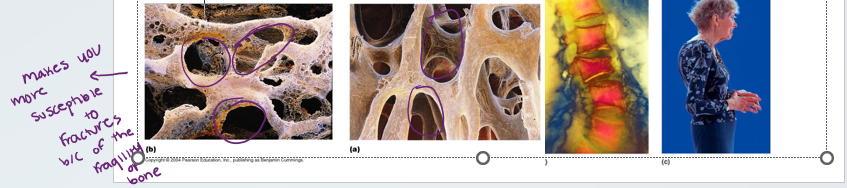 <p><span>•</span><span style="font-family: Arial">Group of diseases in which bone reabsorption outpaces bone deposit</span></p><p><span>•</span><span style="font-family: Arial">Spongy bone of the spine is most vulnerable</span></p><p><span>•</span><span style="font-family: Arial">Occurs most often in postmenopausal women</span></p><p><span>•</span><span style="font-family: Arial">Bones become so fragile that sneezing or stepping off a curb can cause fractures</span></p>