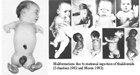 <ol><li><p class="">Used to treat <strong>morning sickness</strong> (1957–61)</p></li><li><p class="">Caused <strong>meromelia</strong> (limb reduction defects)</p></li><li><p class="">Still used, but only in <strong>non-childbearing women</strong></p></li></ol><p></p>