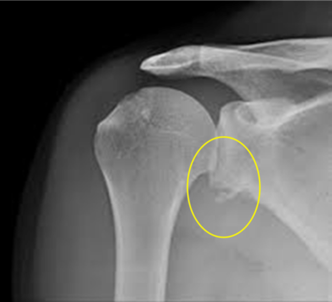 <p>- Bony avulsion of the anterinferior rim of the glenoid</p><p>- Seen with a Hill-Sachs lesion</p>
