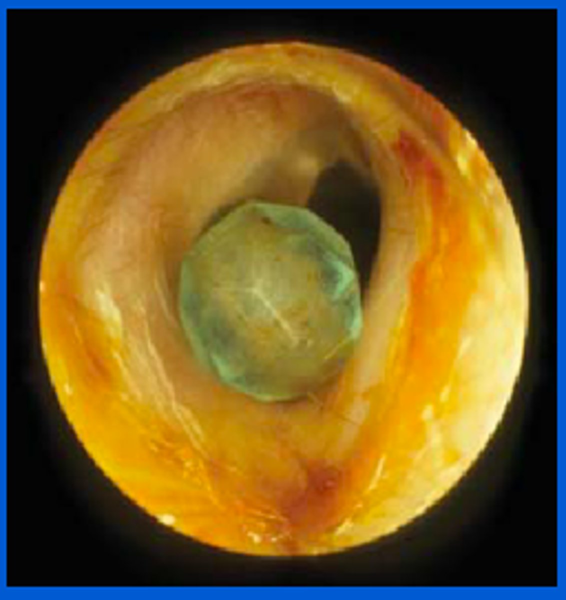 <p>Term used to describe anything out of the ordinary in the external ear canal such as raisins, pebbles, insects, and other assorted small objects.</p>