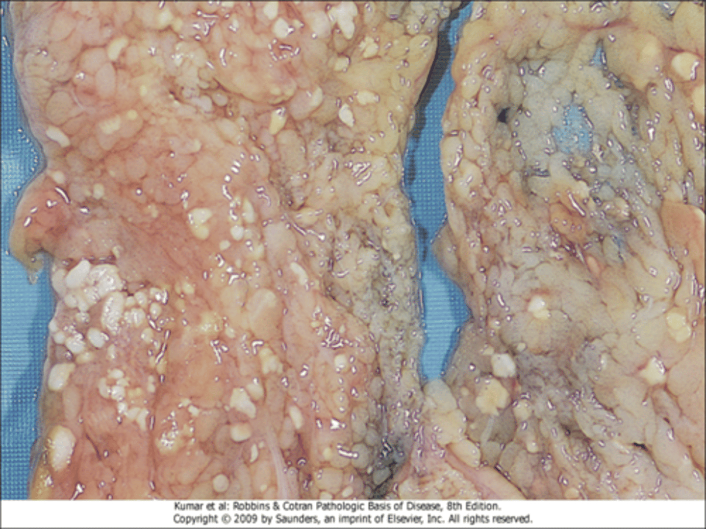 <p>focal areas of fat destruction, release of activated pancreatic lipases into the substance of the pancreas and the peritoneal cavity</p>