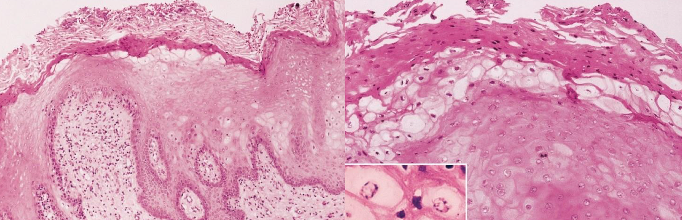 <p>infectious virally modified ballooned cells</p>