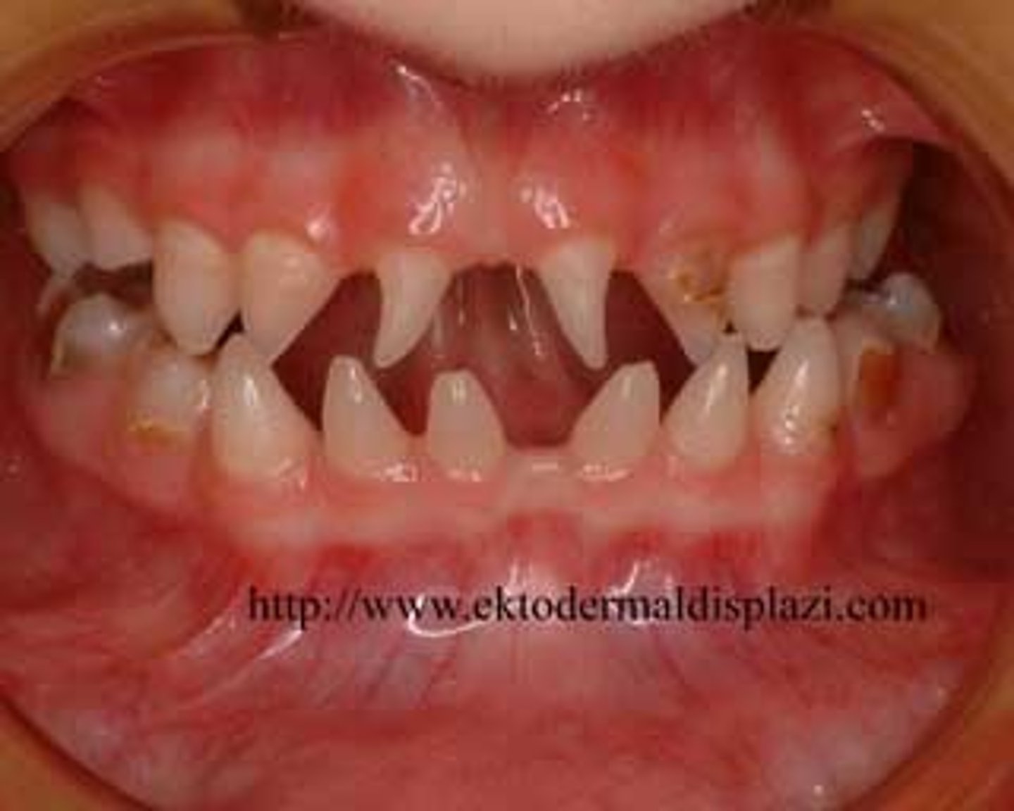 <p>ectodermal dysplasia</p>
