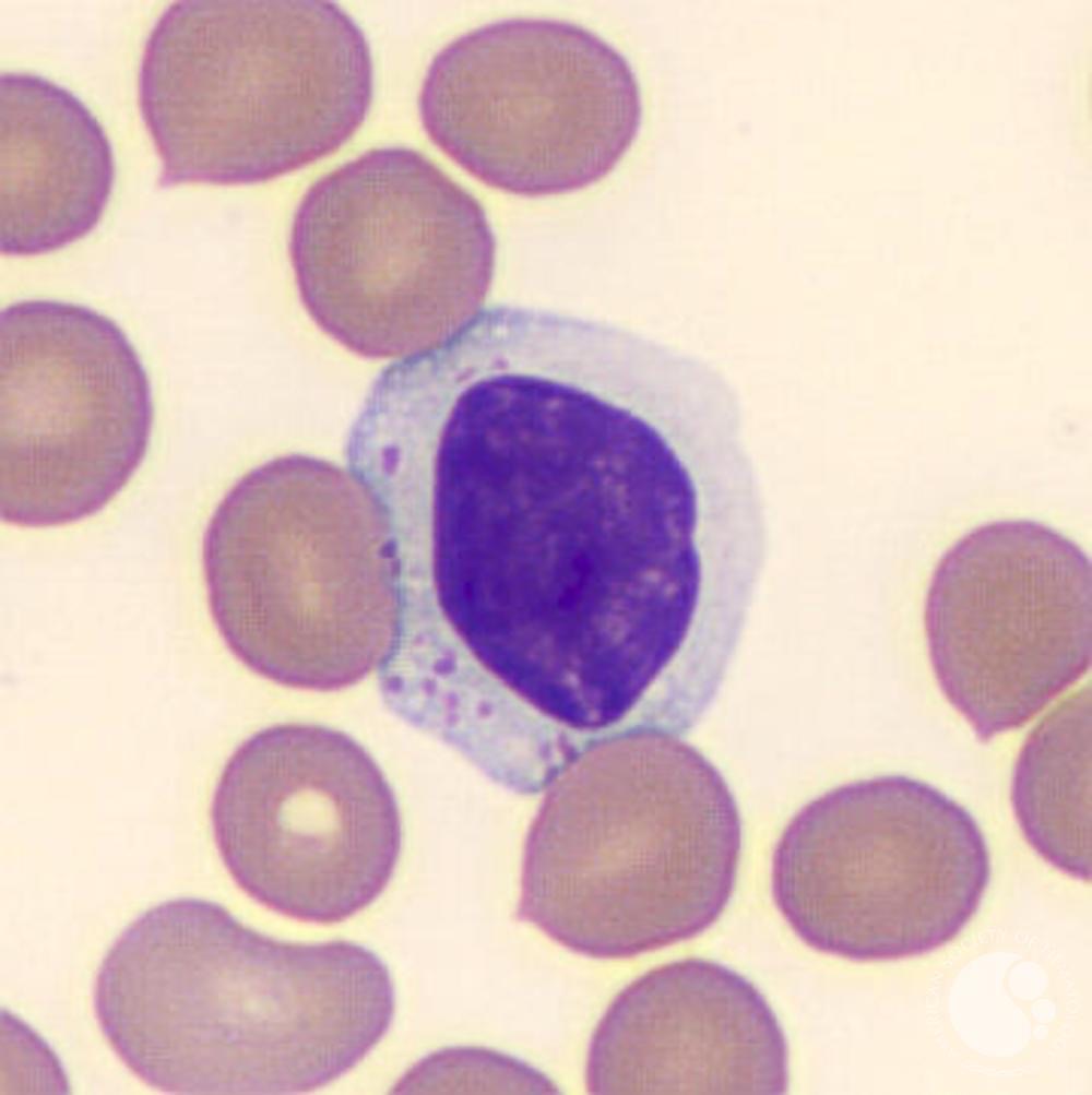 <p>irregular borders and shape with nucleus&nbsp;</p><p>chromatin is a little lighter than a small lymph</p><p>N:C ratio is moderate</p>