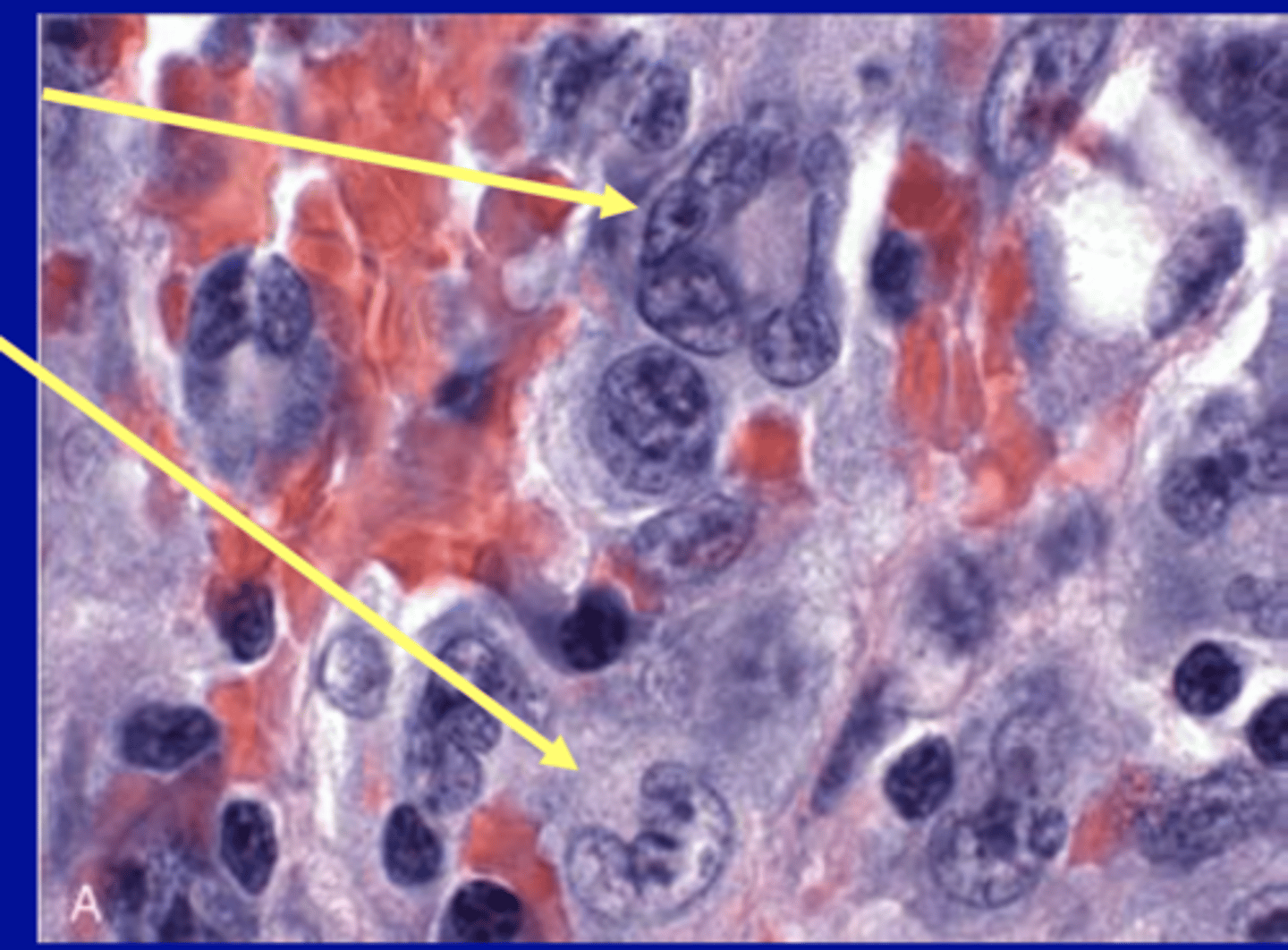 <p>rare type of mature T-cell tumors, characterized morphologically by large lymphoid cells with pleomorphic or horseshoe-shaped nuclei.</p>