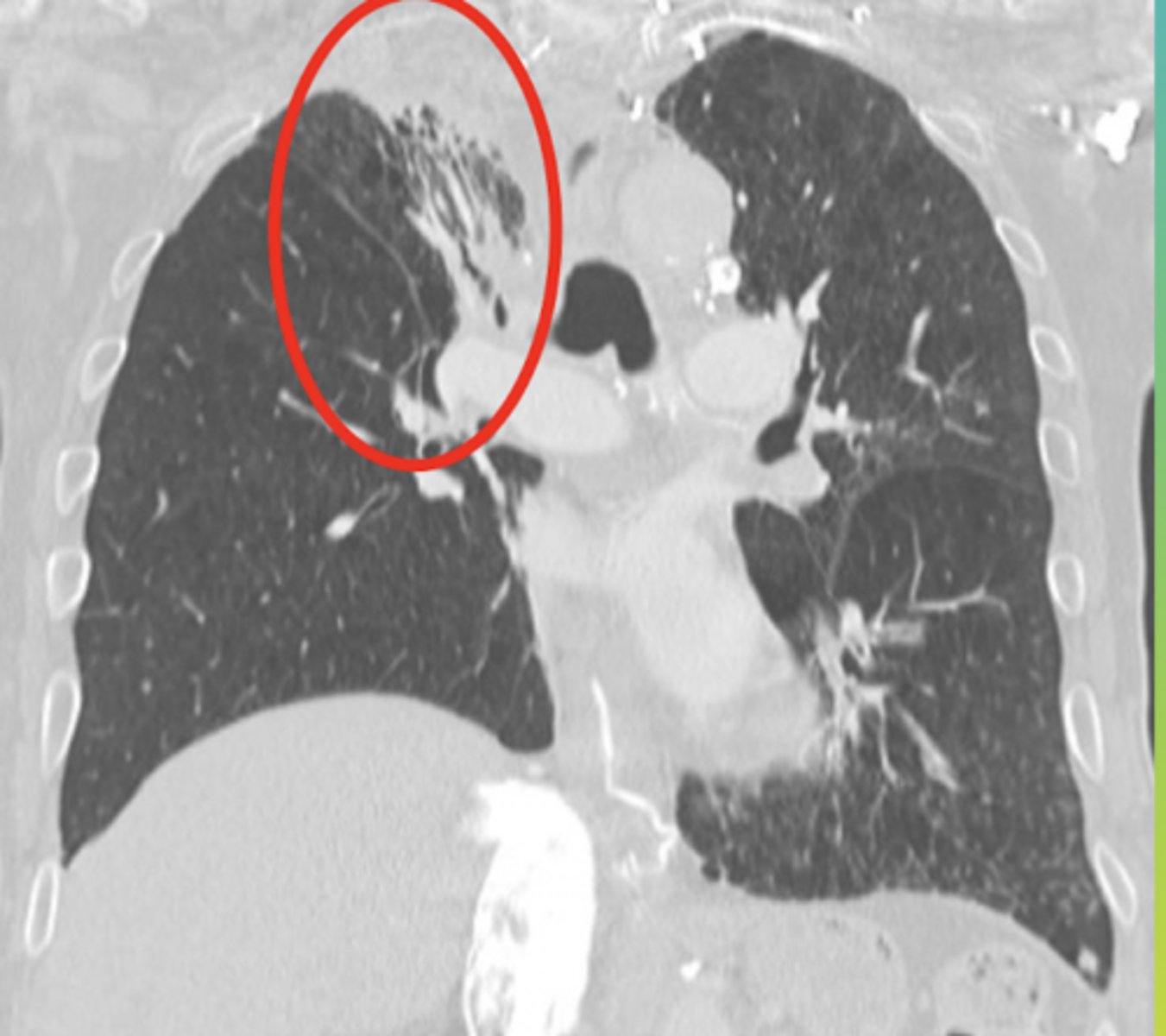 <p>Recently received radiation treatment for breast cancer</p>