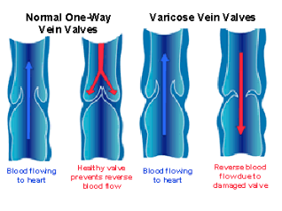 <ul><li><p>have special valves that prevent blood from flowing backwards</p><ul><li><p>flexing of nearby muscles helps push the blood in the right direction</p></li><li><p>if valves wear out, blood can build up in areas causing varicose veins</p></li></ul></li></ul><p></p>