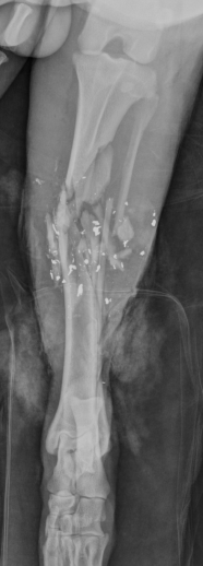 <p><span>Excessive soft tissue damage, highly comminuted, major contamination, typically caused&nbsp;by outside-to-inside high energy trauma (e.g., gunshot).&nbsp;</span><br><br><span>There are three subtypes of type III open fractures.</span></p>