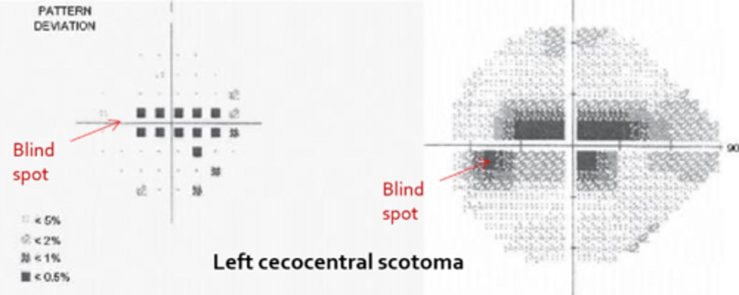 <p>child = congenital defect like optic pits, Leber's optic atrophy</p><p>adult = toxic/nutritional</p>