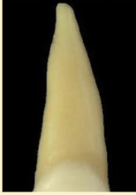 <p><mark data-color="blue" style="background-color: blue; color: inherit">maxillary central incisors #8 and #9; root cross section</mark></p>