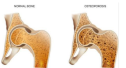 <p>Patho Ostéoporose </p>