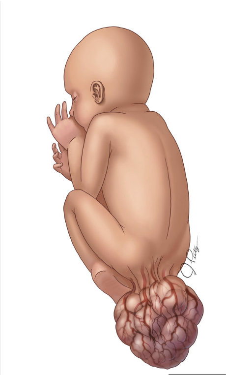 * unusual tumor in the newborn located at the base of the tailbone (coccyx)
* more common in females than males
* very large, but not malignant
* cured by surgery after birth