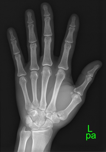 <p>Describe the abnormality demonstrated.</p>