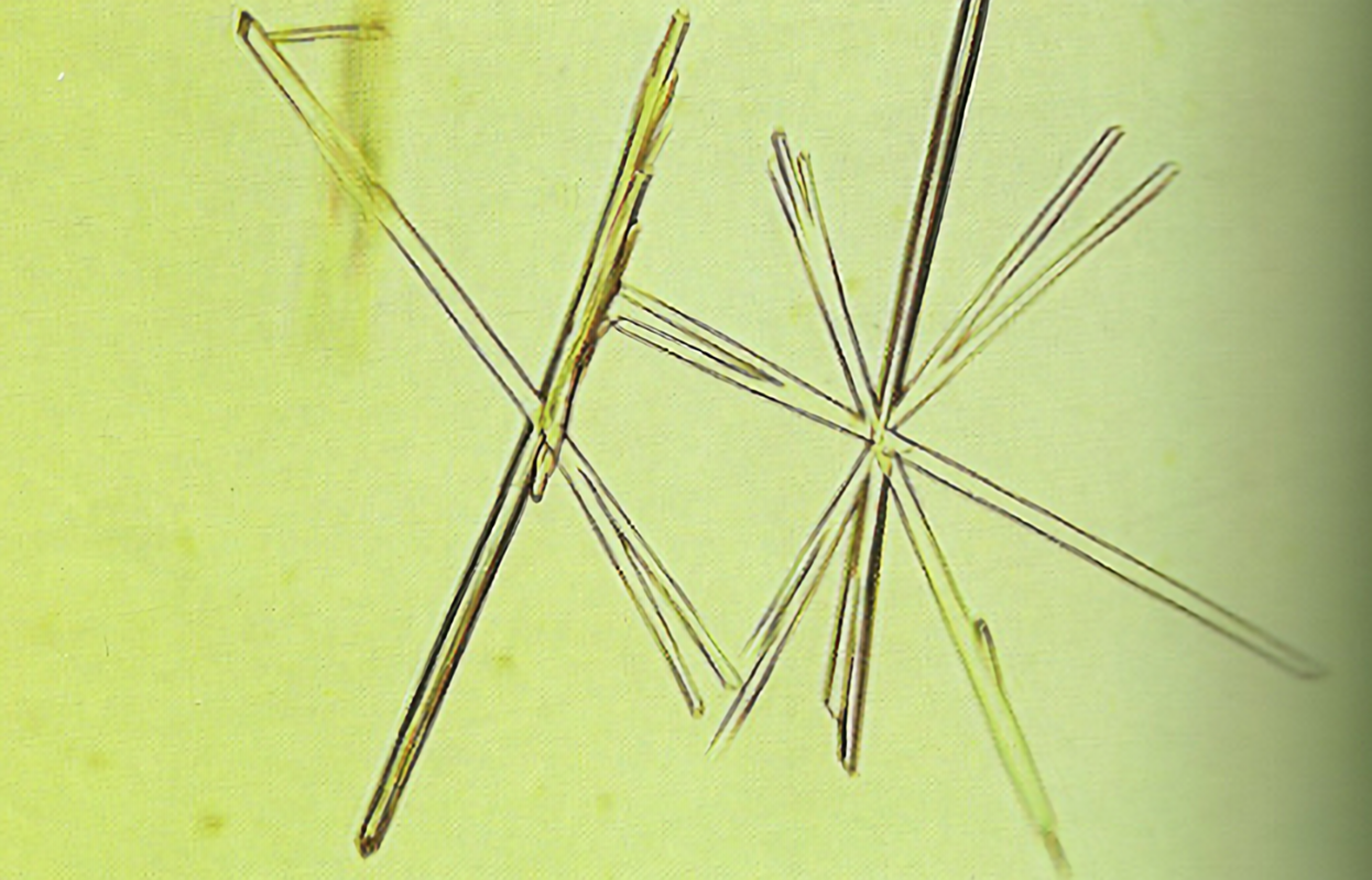<p>Associated with high SG results by refractometer </p>
