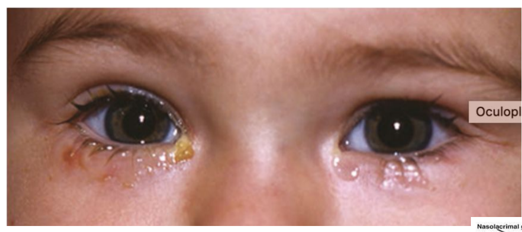 <p>What is this clinical condition</p>