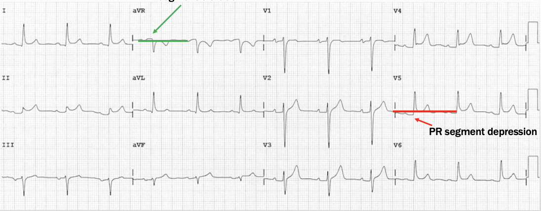 <p>PR depression &amp; global concave ST elevation w/ no reciprocal changes</p><p>PR segment elevation in aVR (if there is ST depression in any lead other than aVR and V1 or any Q is not pericarditis) </p>