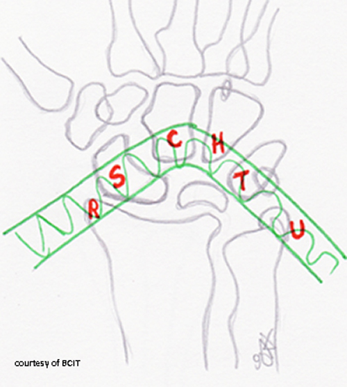 <p>In the vulnerable zone/arch of the wrist — ulnar side gets more severe injuries.</p>